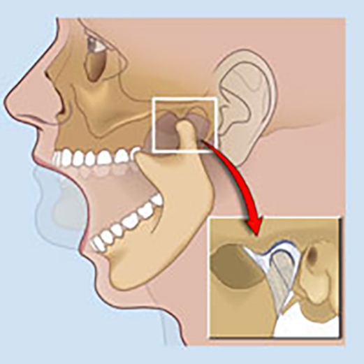 Jaw Joint Disorders