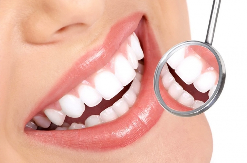 Teeth Whitening (Bleaching)