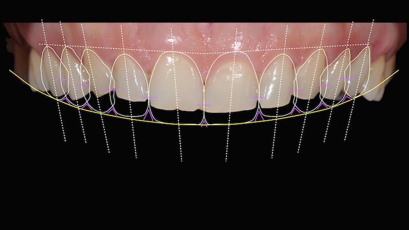 Smile Design