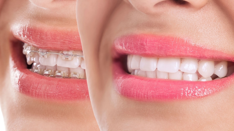 Braces Treatment (Orthodontics)